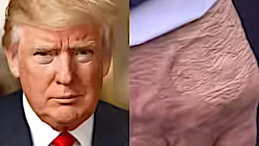 Trump Diagnosed with Vein Disorder – White House Confirms